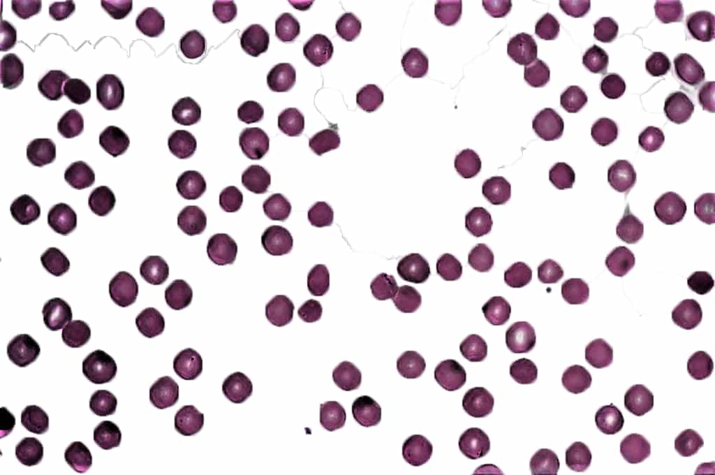 hereditary spherocytosis - types of anemia - laboratory hub