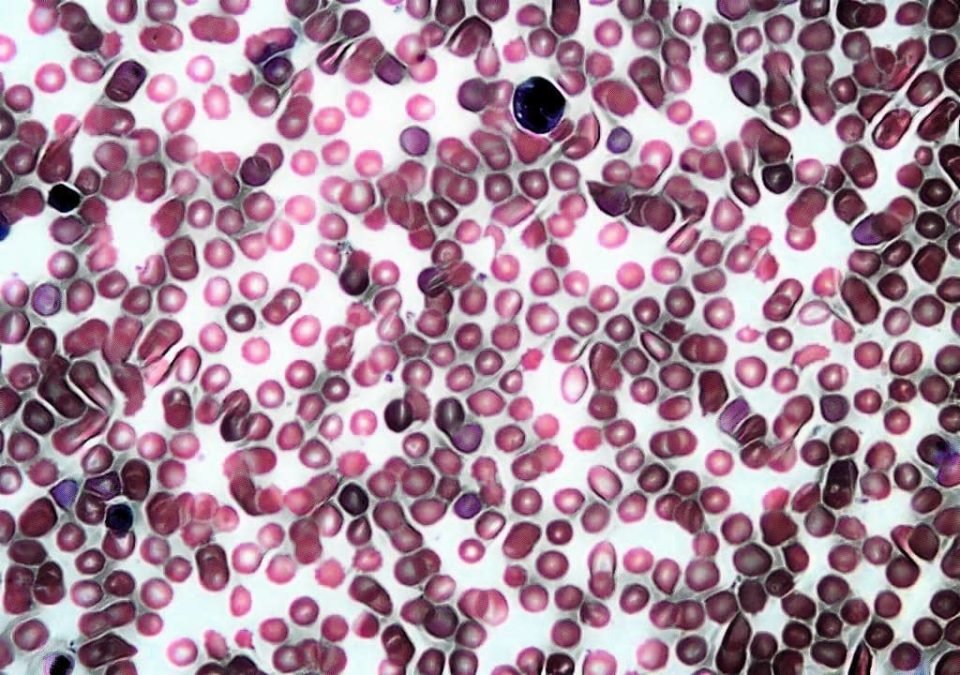 PERIPHERAL BLOOD SMEAR - DIFFERENTIAL LEUCOCYTE COUNT - LABORATORY HUB - PBS - PERIPHERAL BLOOD FILM - THIN BLOOD SMEAR - PERIPHERAL BLOOD FILM - BLOOD SMEAR - BLOOD FILM