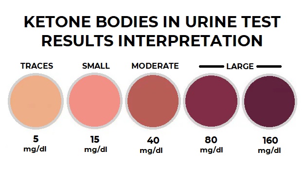 Results and interpretation of ketone bodies test in urine using reagent strip method