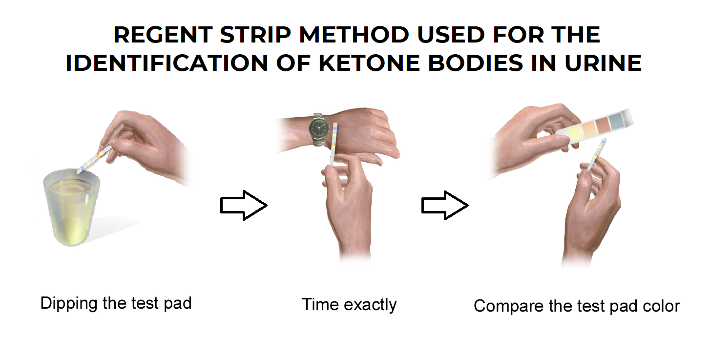 ketone bodies in urine test using reagent strip method